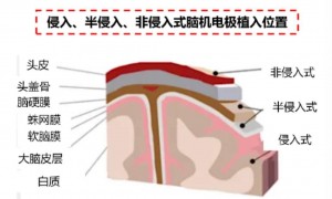 脑机接口虚火？但再不下手就晚了